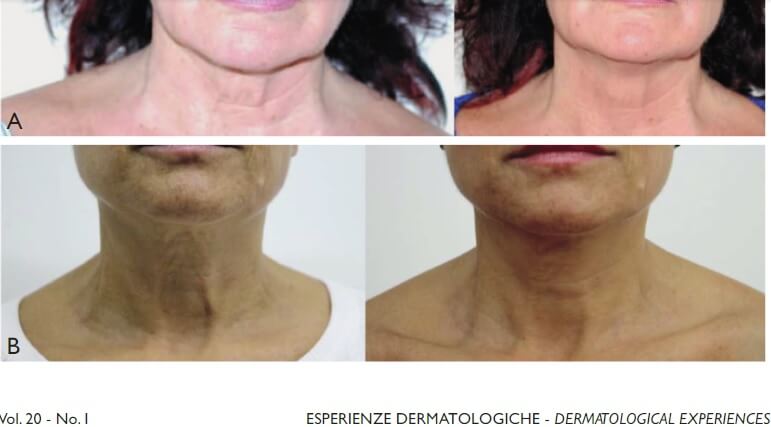 before after profhilo treatment