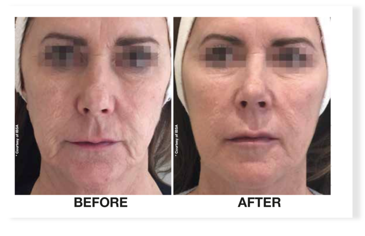 Before After Perawatan Hyaluronic Acid Profhilo