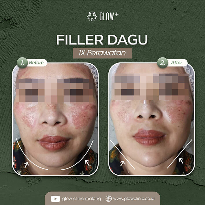 Anti aging - Before & Affter Suntik filler Dagu di Glow+ Clinic