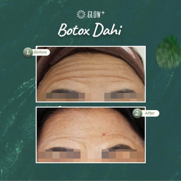 Before & After Botox Dahi